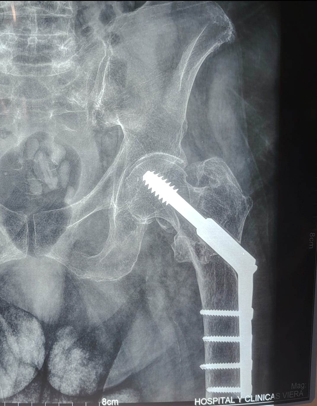 Imagen de fractura de cadera  manejada con Tornillo Deslizante de Cadera