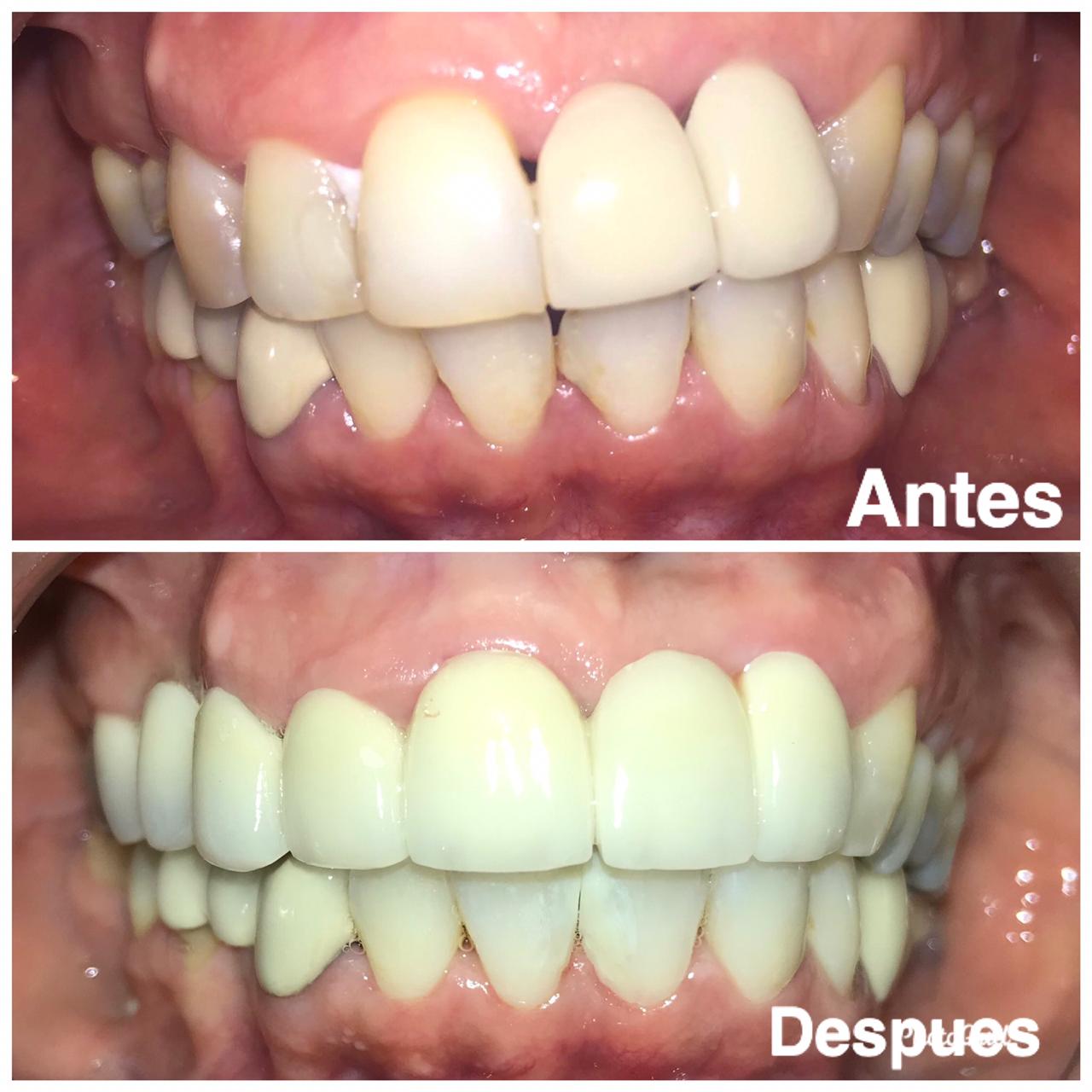 Prótesis Fijas (Antes y Después)