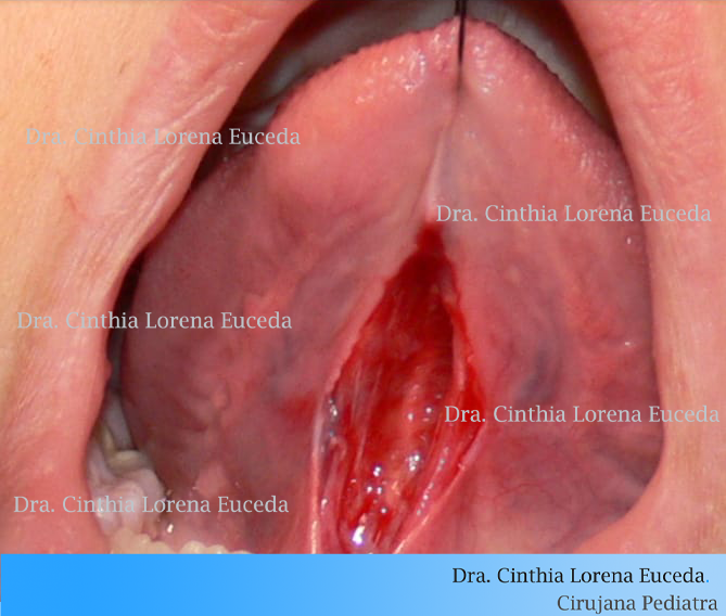 Frenillo lingual transoperatorio