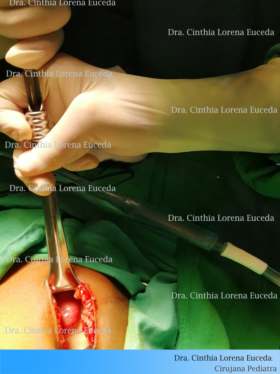 Apéndices complicadas con peritonitis que he operado