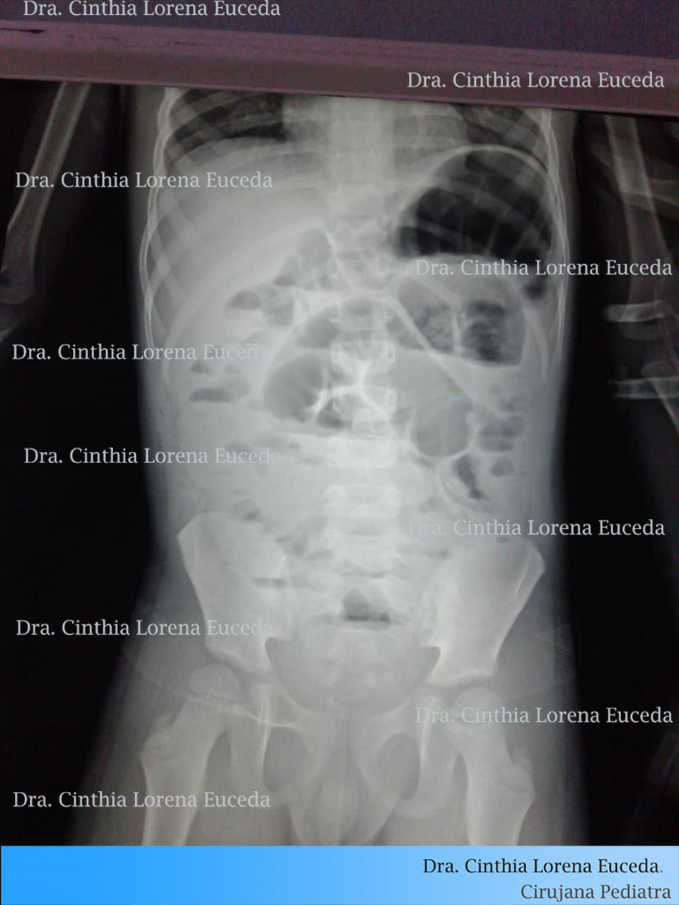 Apéndices complicadas con peritonitis que he operado