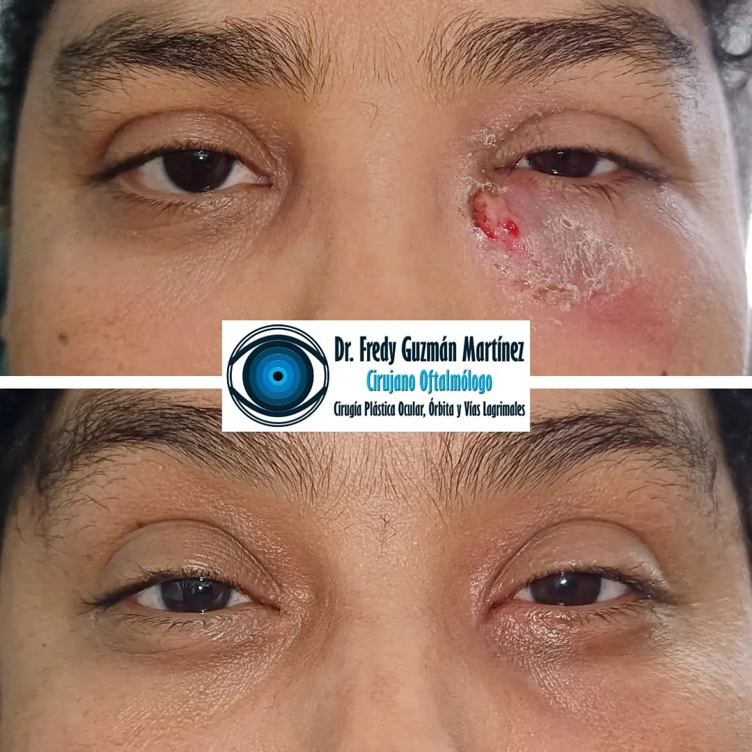 Dacriocistorrinostomía externa realizada por fístula dacriocutánea secundario a dacriocistitis crónica agudizada