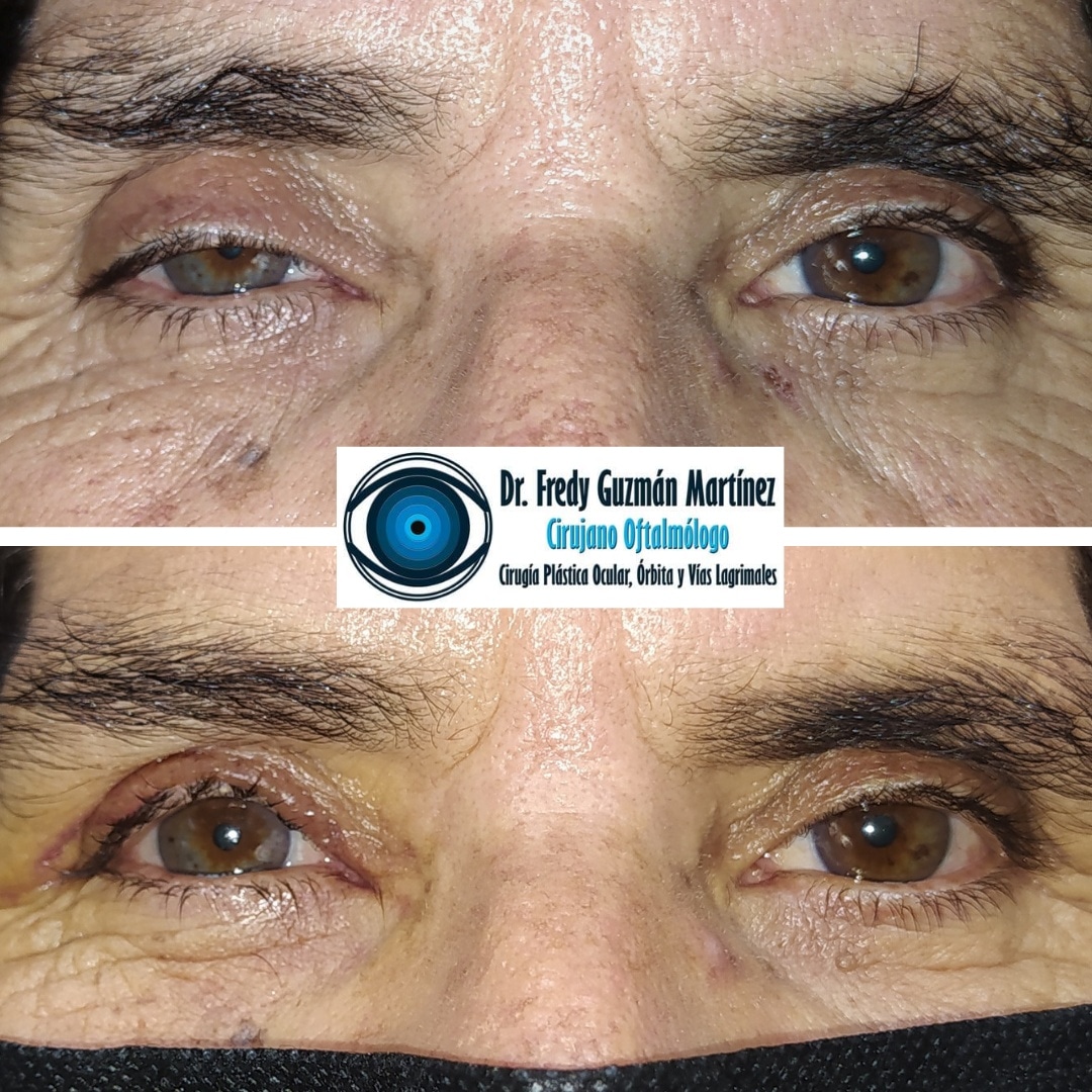 Corrección de ptosis palpebral de ojo derecho.