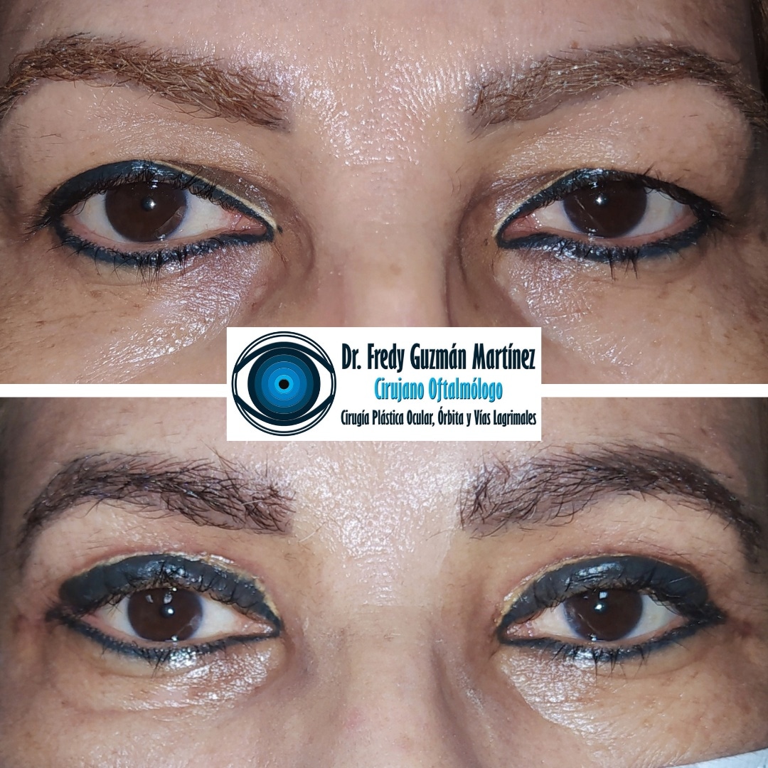 Corrección de ptosis palpebral de ojo derecho.