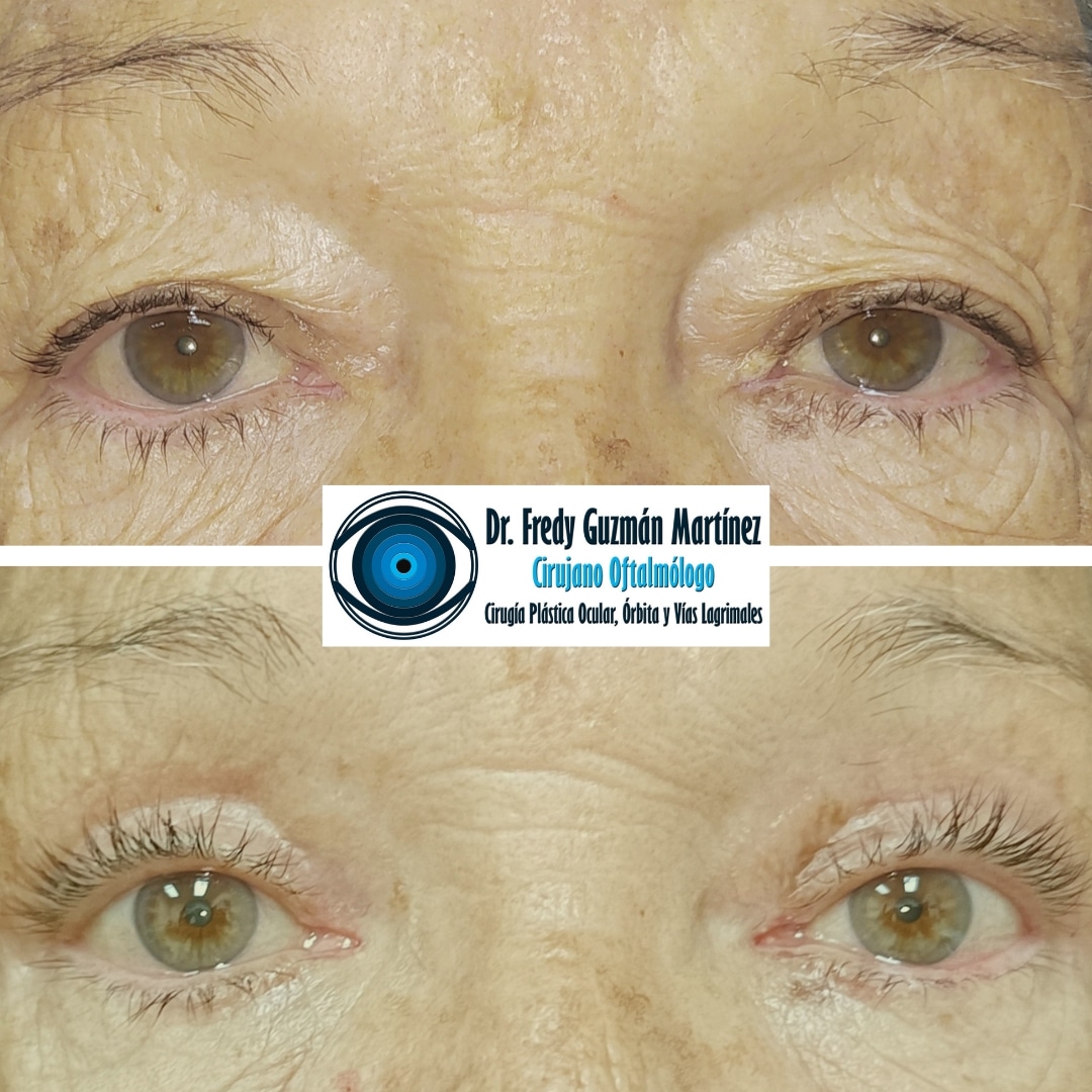 Blefaroplastía superior de ambos ojos.