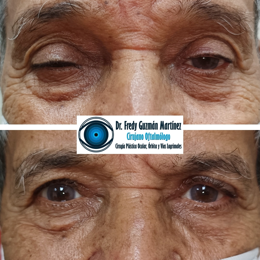 Blefaroplastía superior más corrección de ptosis palpebral de ambos ojos.