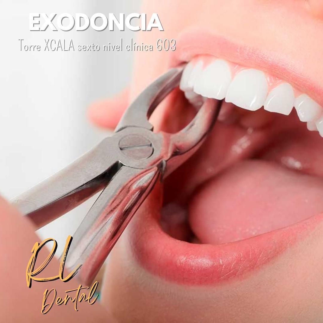 Exodoncia 