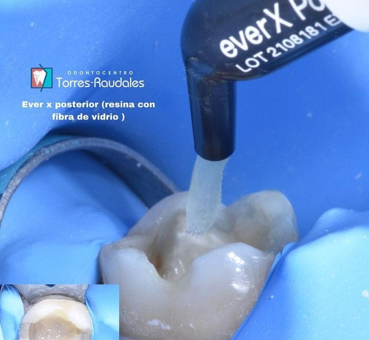 Resina con fibra de vidrio