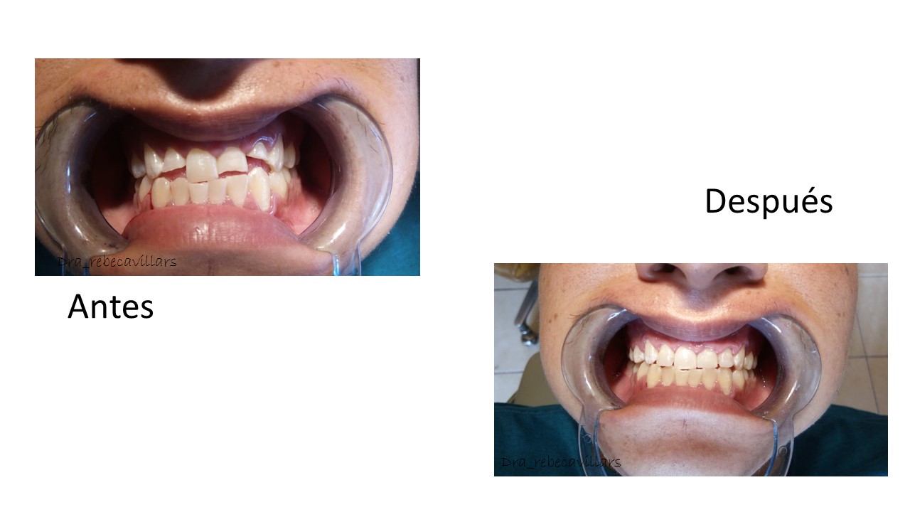 Fractura de piezas dentales anteriores a causa de una caida, se trabajó en una sola cita con resinas de álta estética par devolver la sonrisa.