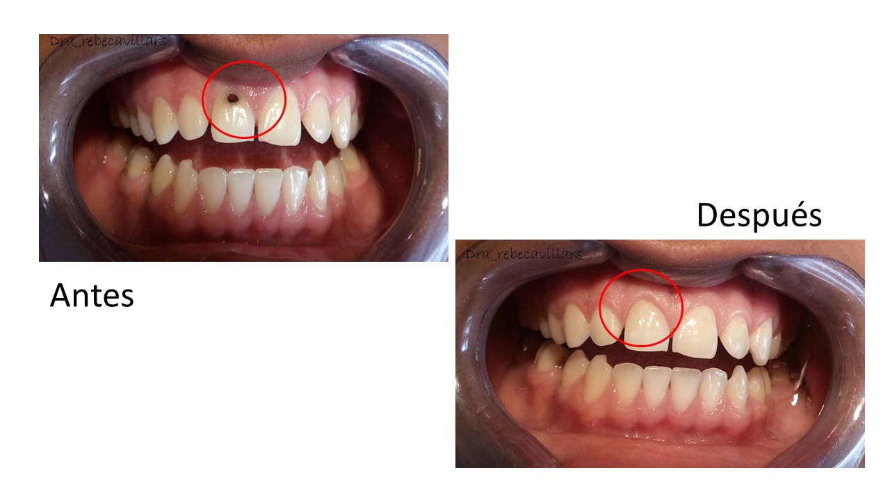 Caries extensa en pieza dental anterior, se trabajó con resina de álta estética para devolver la naturalidad y salud al diente.