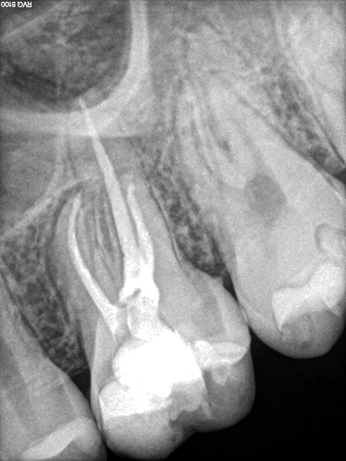 Endodoncia Finaliza Primer Molar Superior 