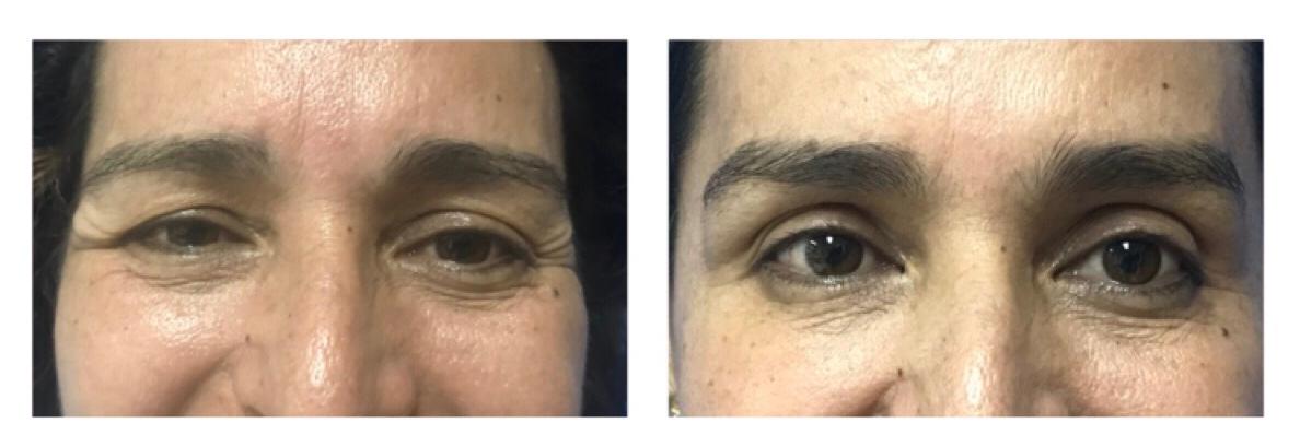 Rejuvenecimiento de tercio superior de cara con toxina Dysport, levantamiento de ceja y disminución de arrugas.