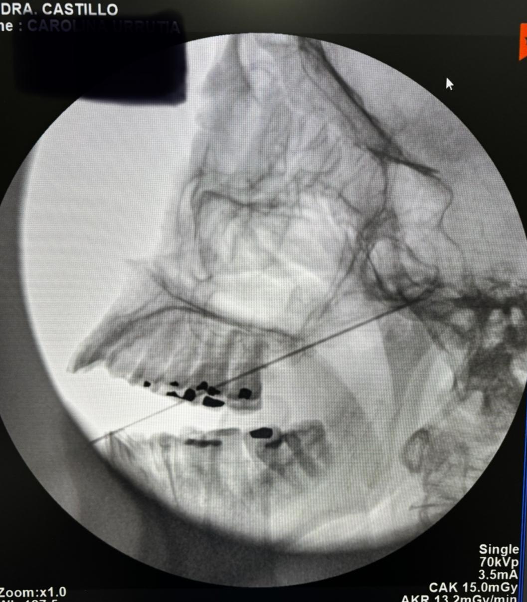Radiofrecuencia de ganglios de Gasser por neuralgia del trigémino