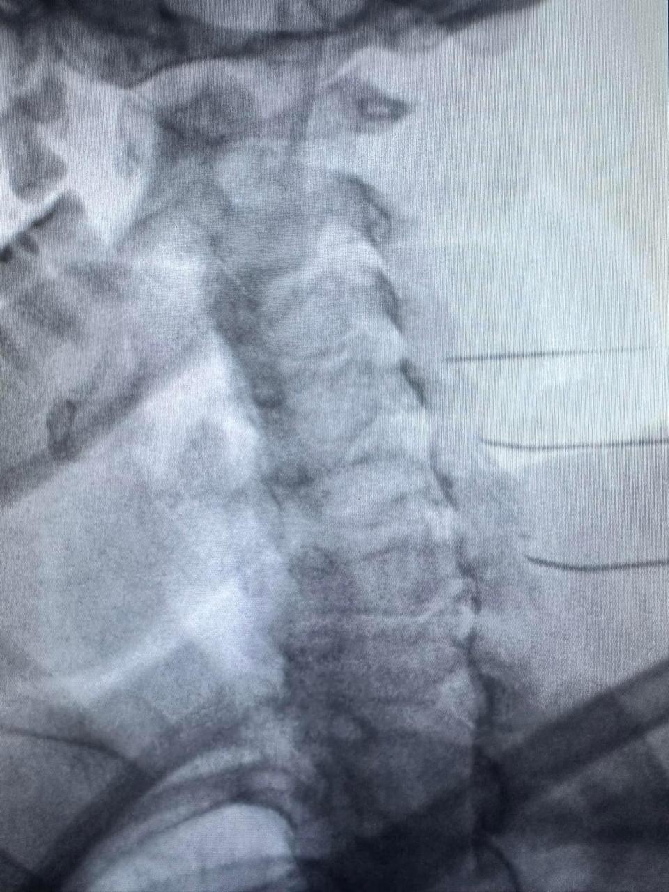 Radiofrecuencia de facetas columna cervica